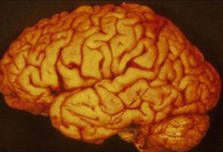 Immune genes 'key in Parkinson's disease' 