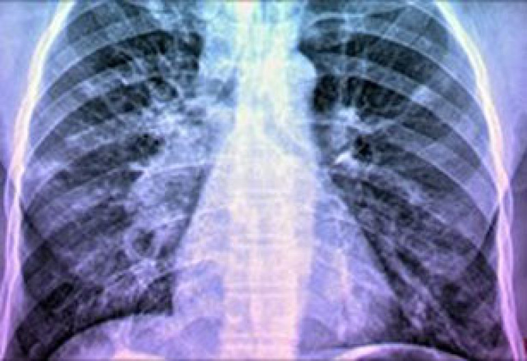 Predictive blood test for TB 'a step closer'