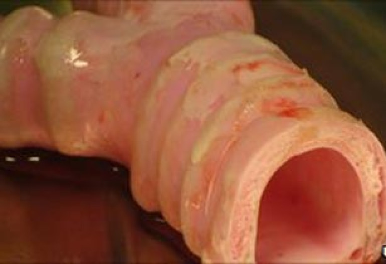 Doctors make first synthetic organ transplant