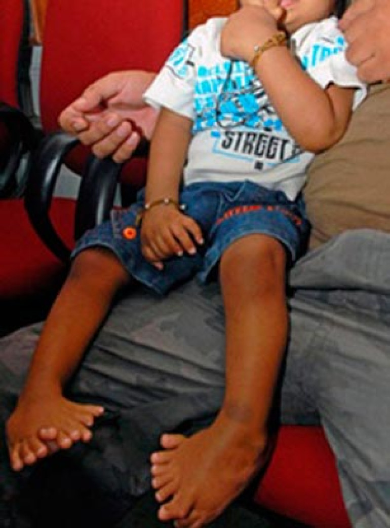 Indian child with 34 fingers breaks world record