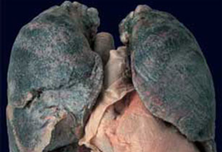 Time of first cigarette indicates cancer risk