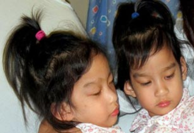 Surgeons separate conjoined twins in California