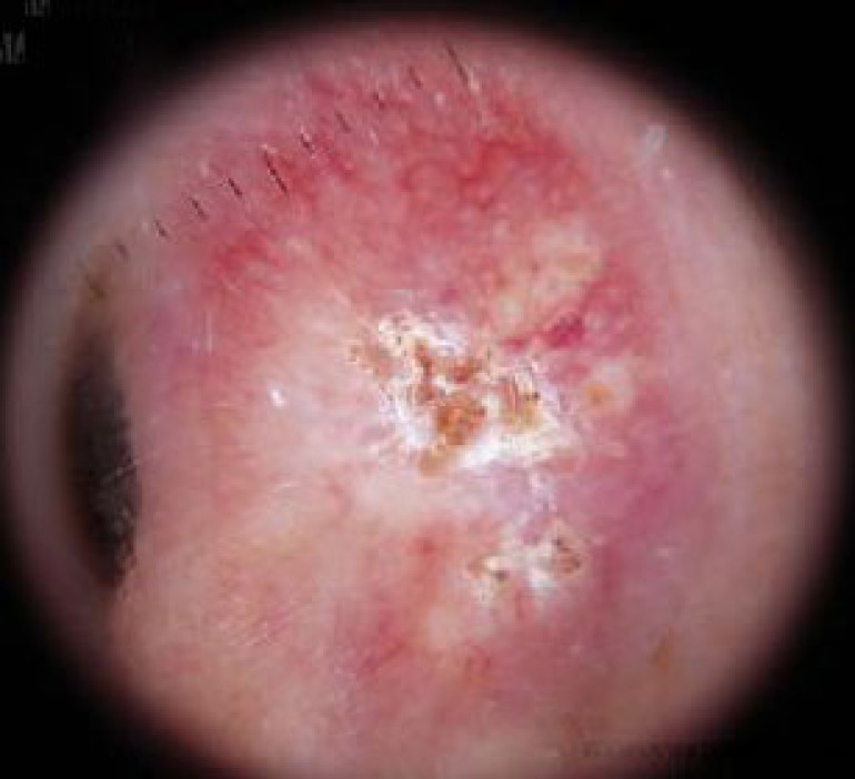 Coffee, exercise may reduce skin cancer risk