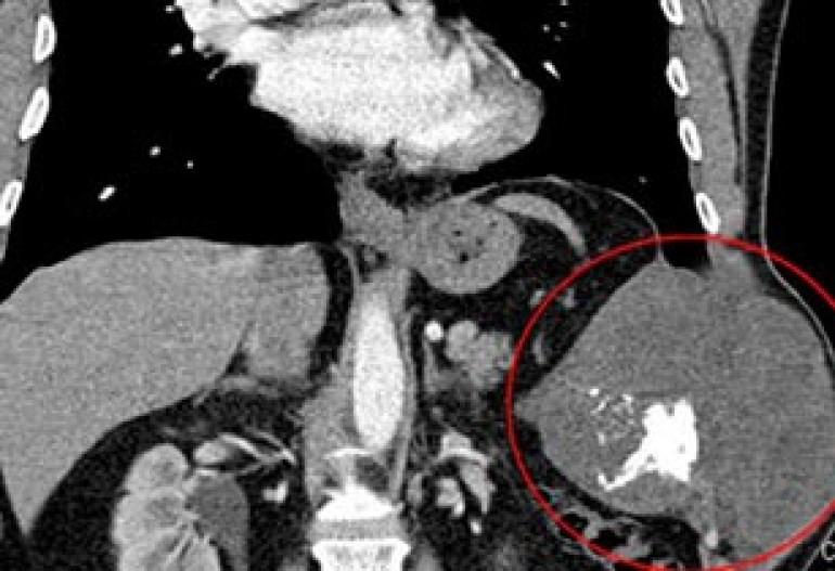 Doctors use cement to repair man's chest after tumour operation