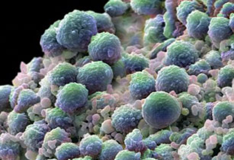 British surgeons invent new operation to treat prostate cancer in 30 minutes