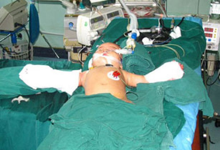 Doctors re-attach baby’s hands cut by grandmother