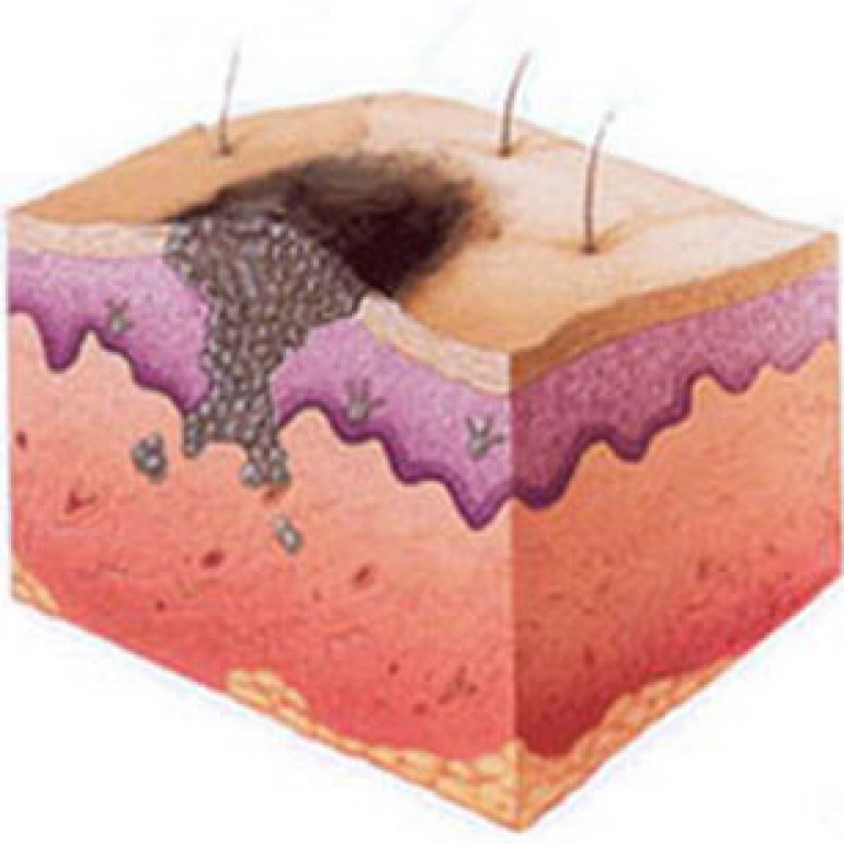 Study identifies way to treat most aggressive skin cancer