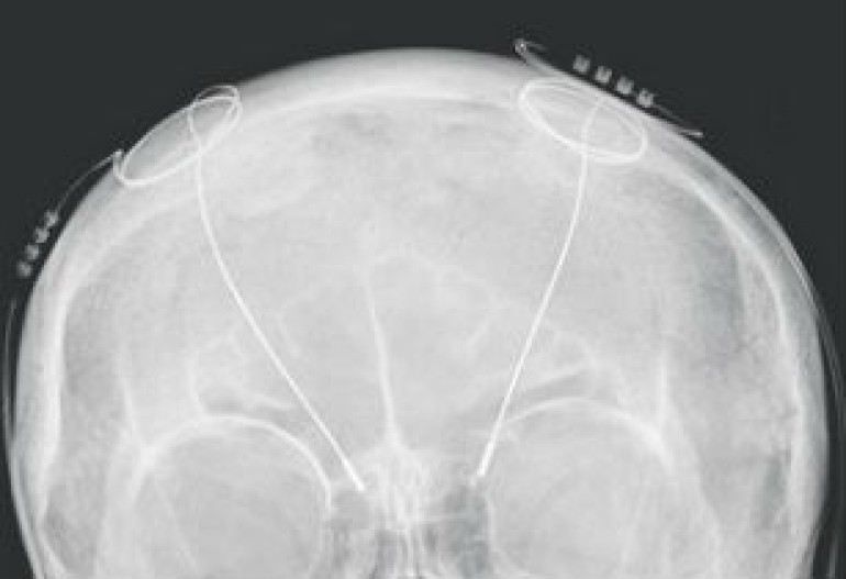 $1m award launched for brain research breakthrough