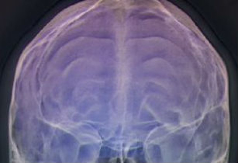 ‘Fat’ drug could treat epilepsy