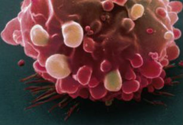 Bowel cancer genes discovered