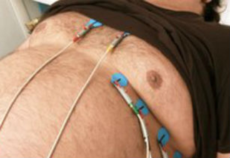 Obesity cuts dying risk in heart patients