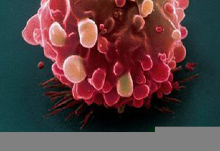 Male bowel cancer on the increase, says Cancer Research