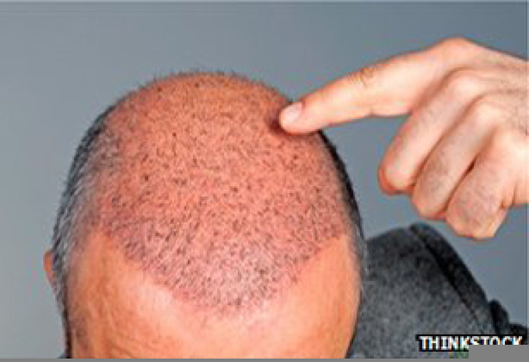Male baldness 'indicates heart risk'