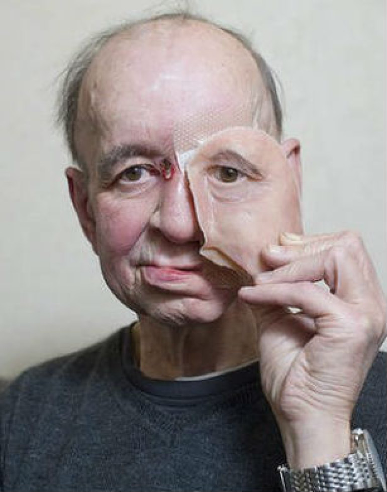 3D-printed face made man's life whole again