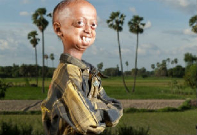 Rare disease leaves boy with body of 110-year-old
