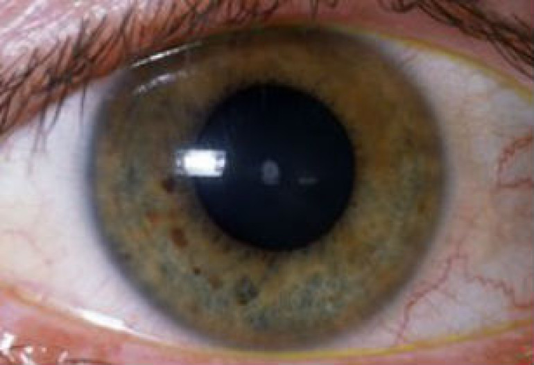 Researchers develop child cataract blood test