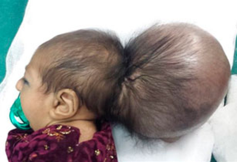 Afghanistan 'two-headed' baby in successful operation