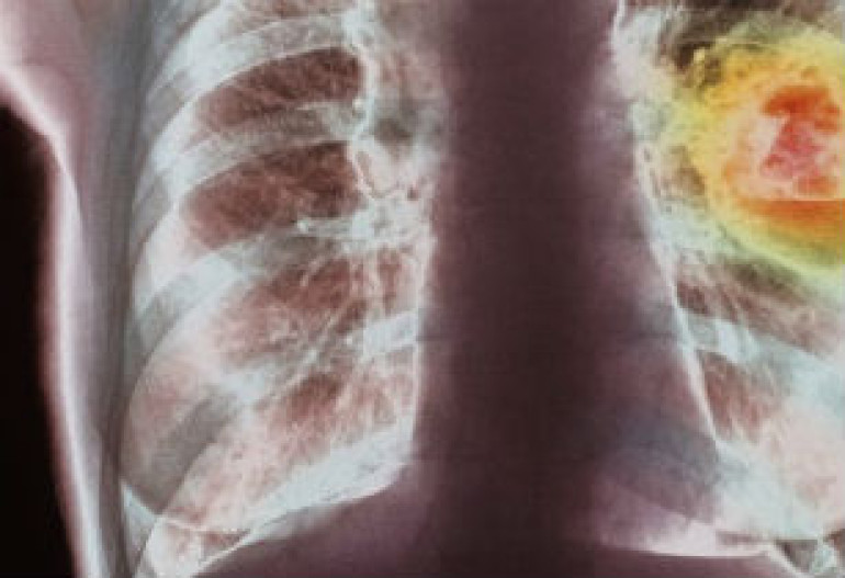 Global cancer cases reach 14 million, World Health Organization warns