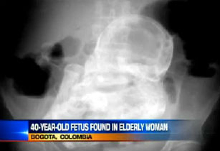 Woman with stomach pain found to have a 40-year-old fetus inside her