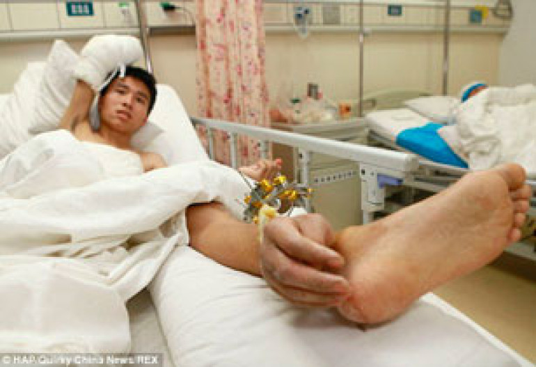 Man whose hand was severed has it attached to his ankle for a month to keep it alive before being reattached 
