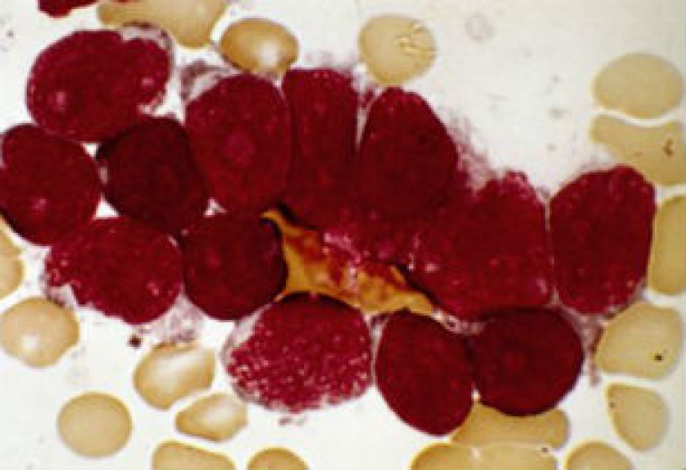 Antibody machinery leukaemia cause