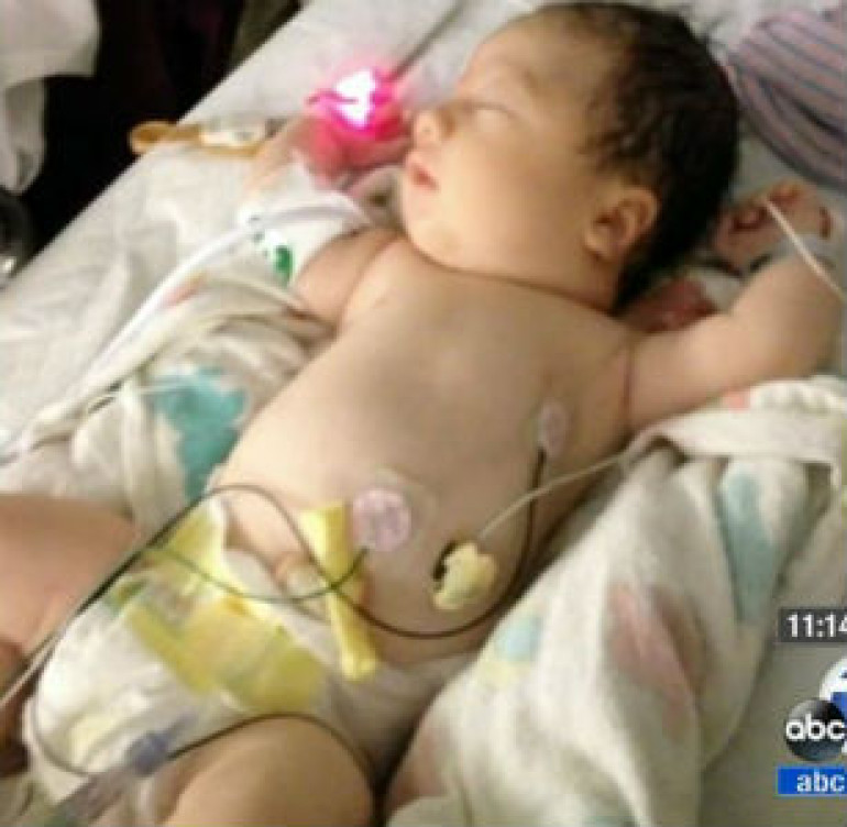 Ghostly pale baby born with almost no blood survives