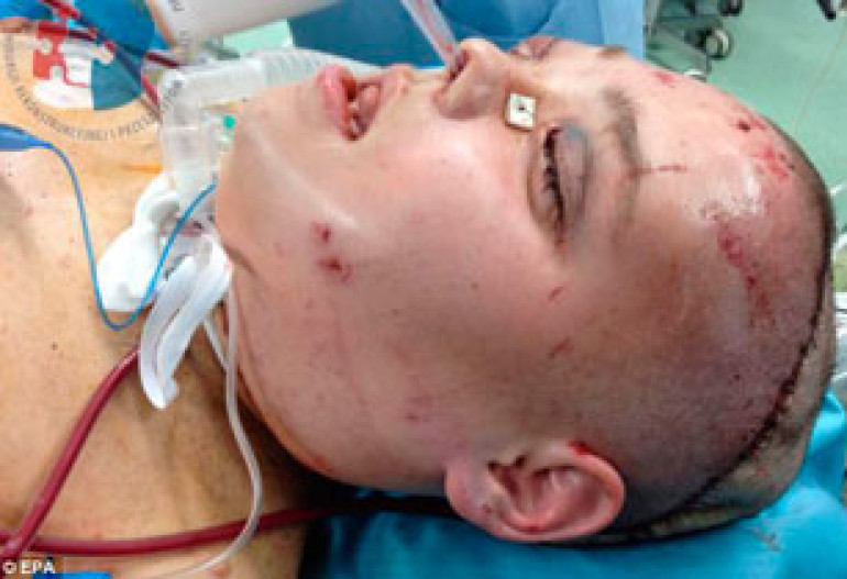 Woman, 26, disfigured by huge facial tumor reveals new face after transplant