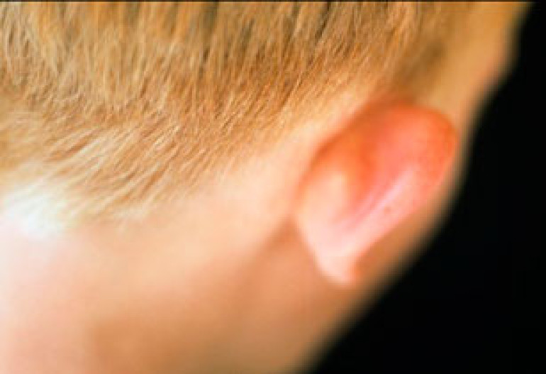 Doctors aim to grow ears from fat