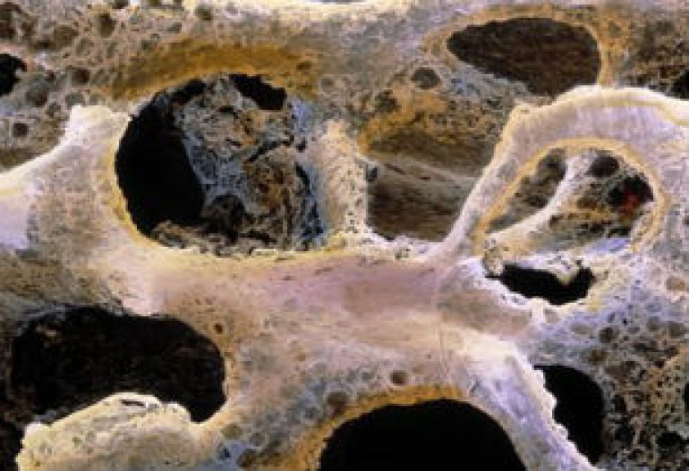 Protein could bring hope to brittle bone disease