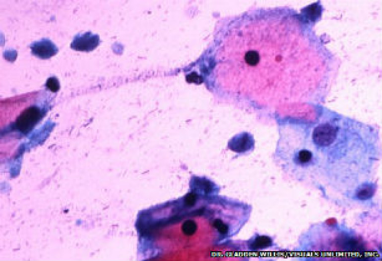 Prostate cancer linked to sex bug