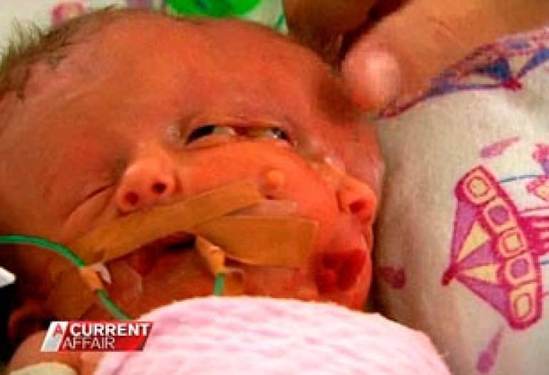 Conjoined twins Faith and Hope die after a 'miraculous' 19-day life