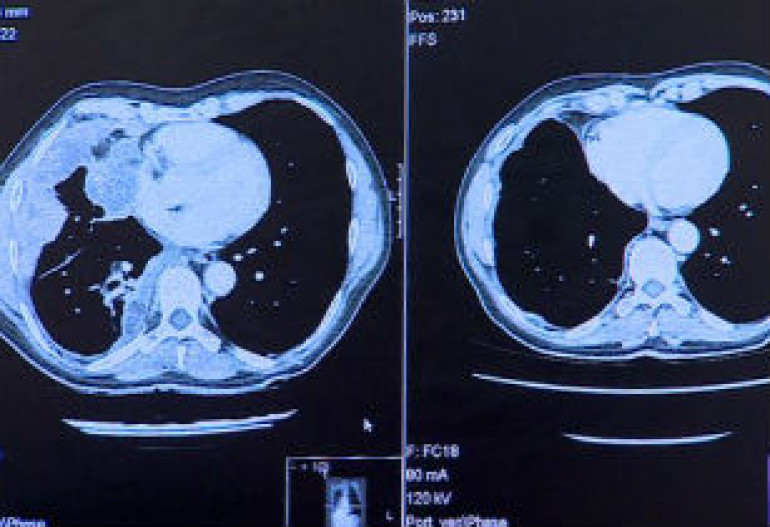 Skin cancer trial results exciting