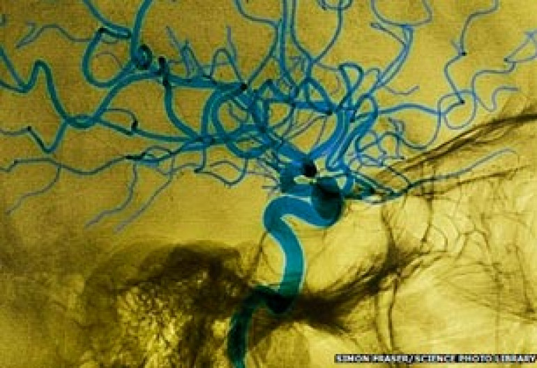 Microwave helmet 'can spot a stroke'