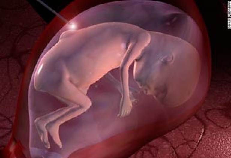 Tiny robotic arm could operate on babies in the womb