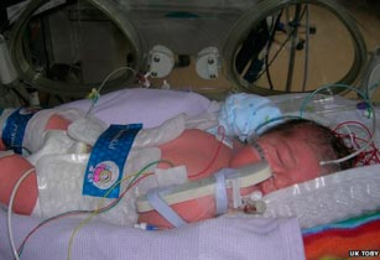 Cooling babies 'helps reduce longer-term brain damage'