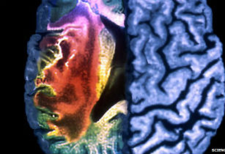 Stems cells applied in stroke therapy