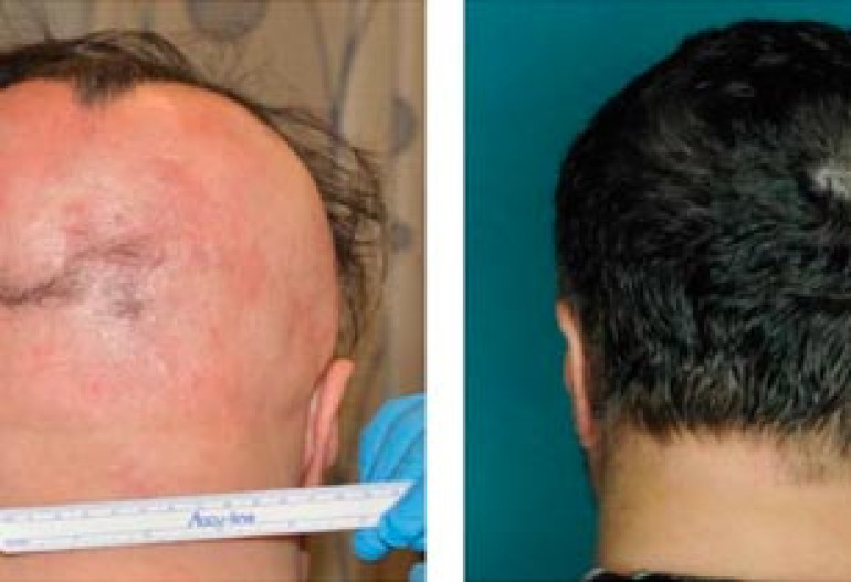 Hair loss reversed in alopecia sufferers