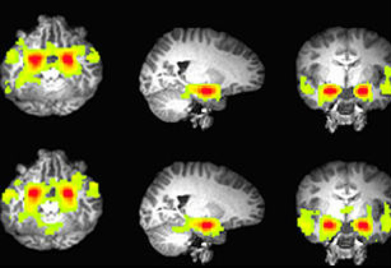 Brain scans reveal secrets of ‘terrible teens’