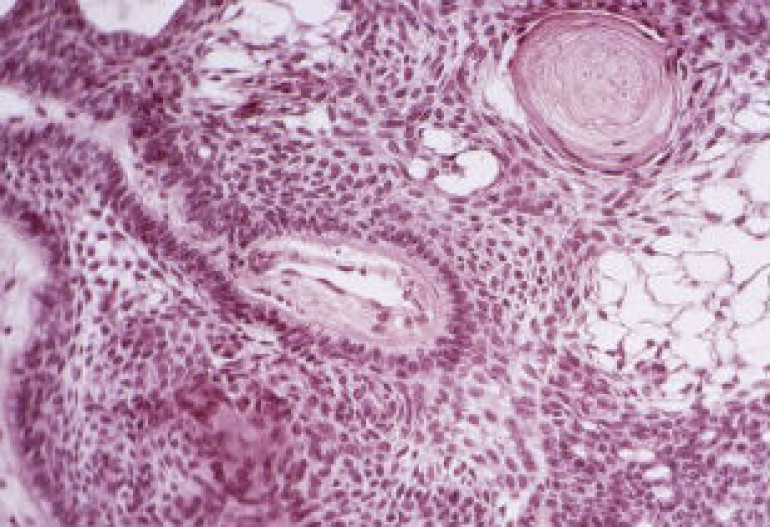 Cancer killing stem cells made in lab