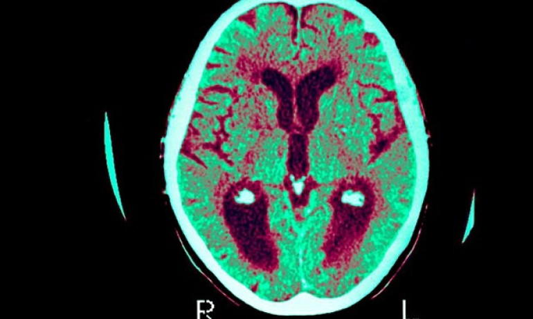 Alzheimer's breakthrough as ultrasound treats disease in mice