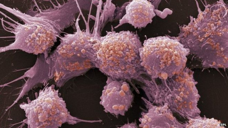 Prostate cancer gene map points way to targeted drugs