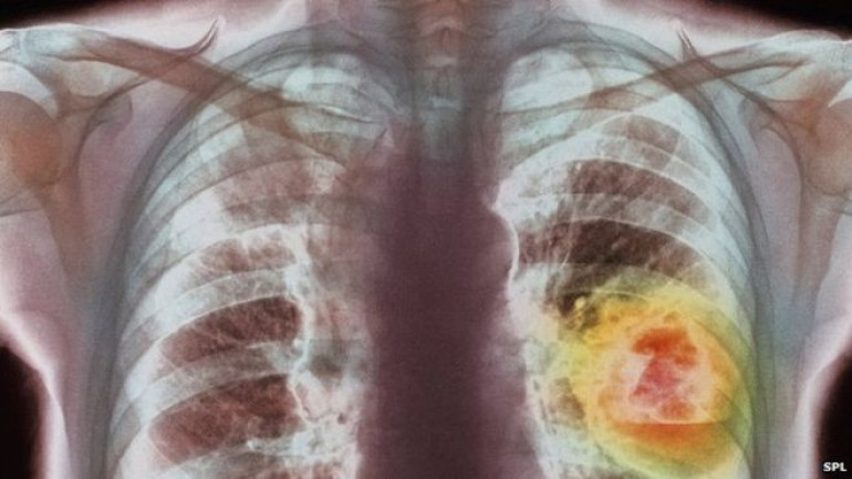 Lung cancer therapy is 'milestone'