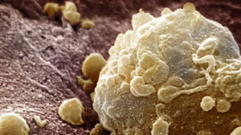 Cancer drug combination 'shrinks 60% of melanomas'