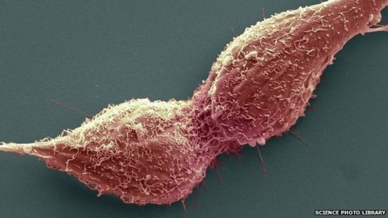 Prostate cancer: Five types 'found'