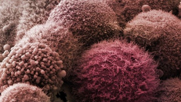 Simple test could detect pancreatic cancer