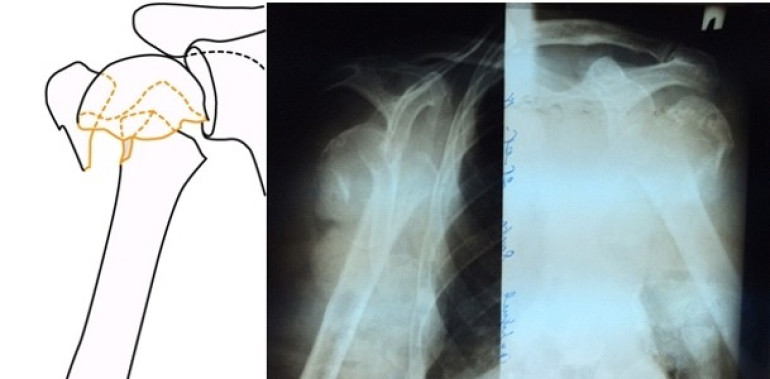 Rare shoulder joint surgery performed in Armenia