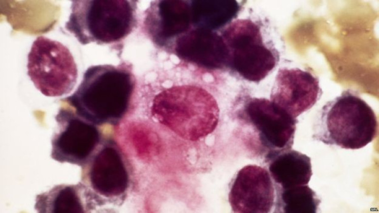 Blood test 'detects cancer relapse'