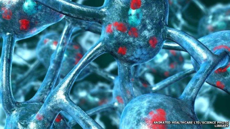 Brain cells 'burn out' in Parkinson's disease