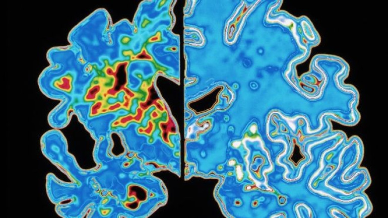 'Transmittable Alzheimer's' concept raised