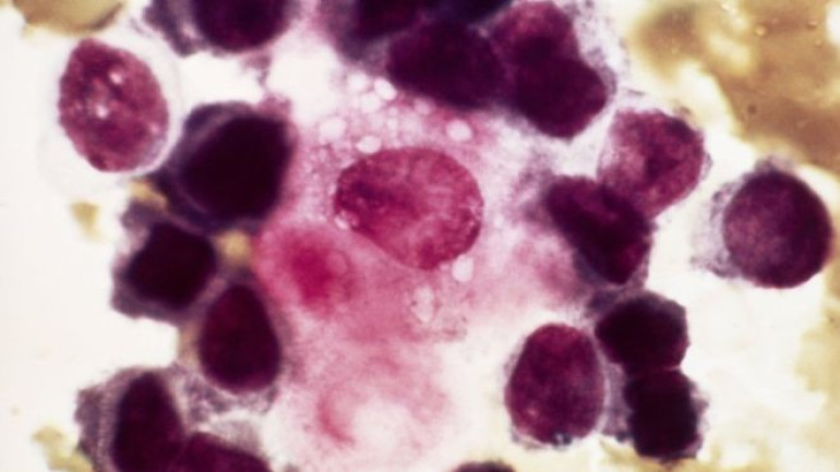 Genetic clue to breast cancer relapses
